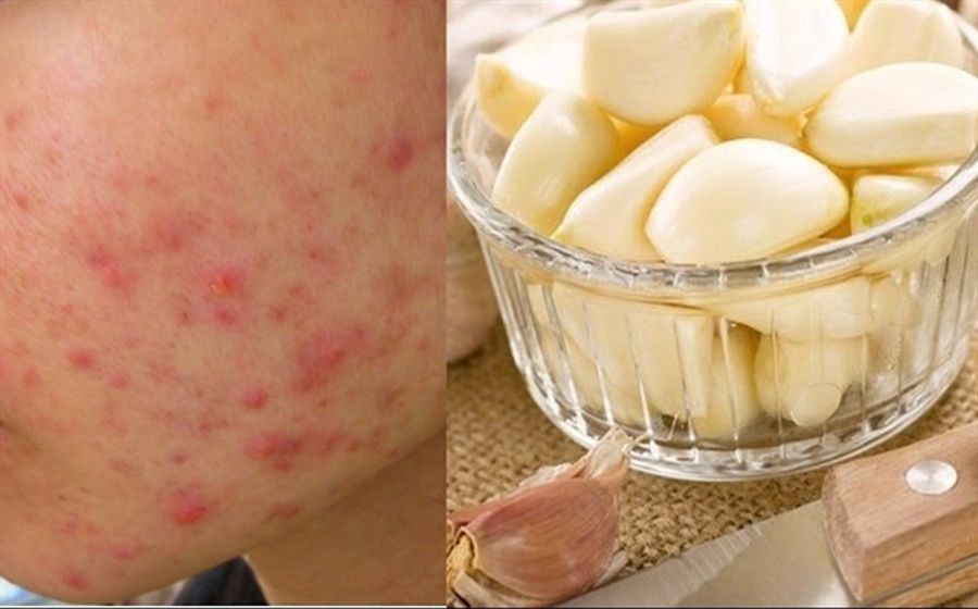 12 cách hỗ trợ làm sạch mụn đỏ, giảm mụn sưng đỏ nhanh chóng cấp tốc