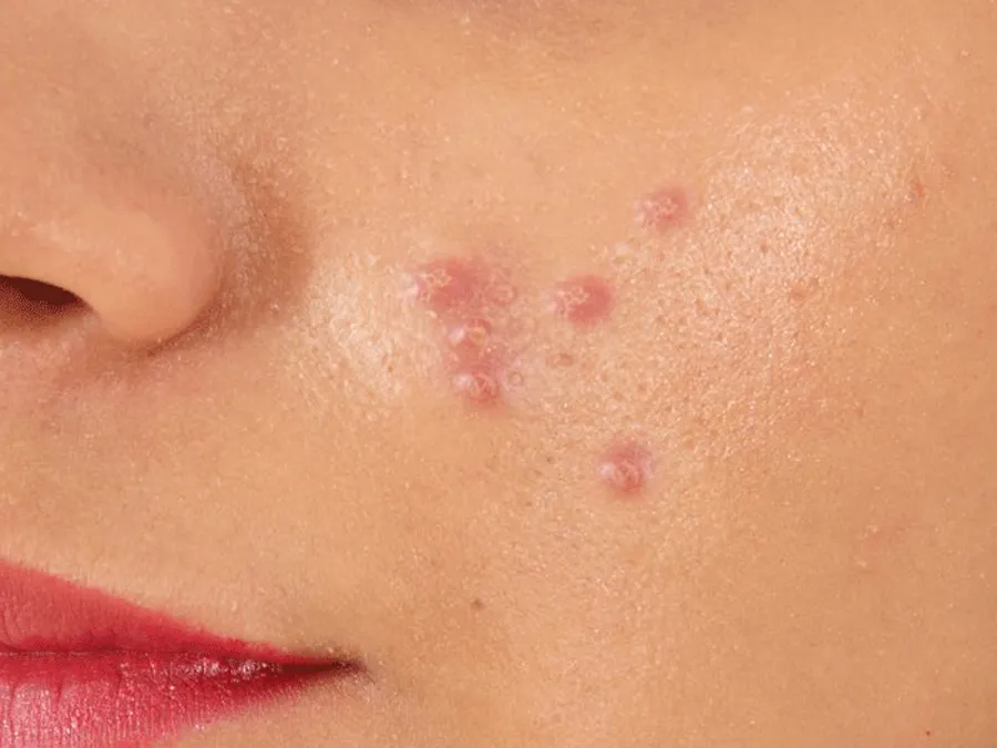 12 cách hỗ trợ làm sạch mụn đỏ, giảm mụn sưng đỏ nhanh chóng cấp tốc