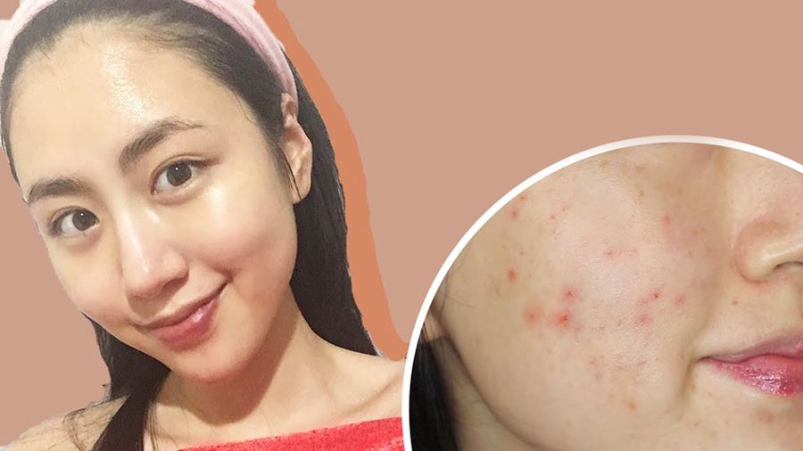 12 cách hỗ trợ làm sạch mụn đỏ, giảm mụn sưng đỏ nhanh chóng cấp tốc