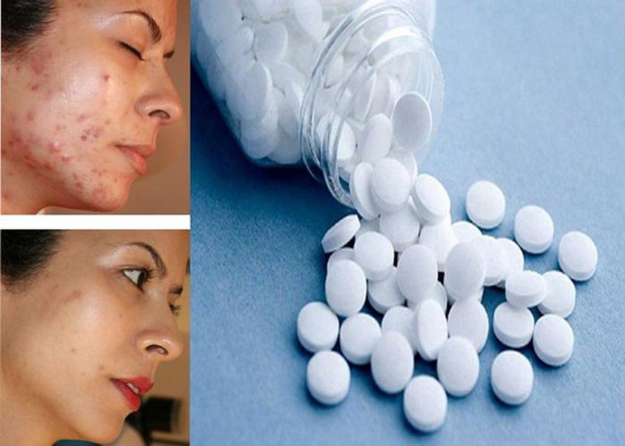 12 cách hỗ trợ làm sạch mụn đỏ, giảm mụn sưng đỏ nhanh chóng cấp tốc