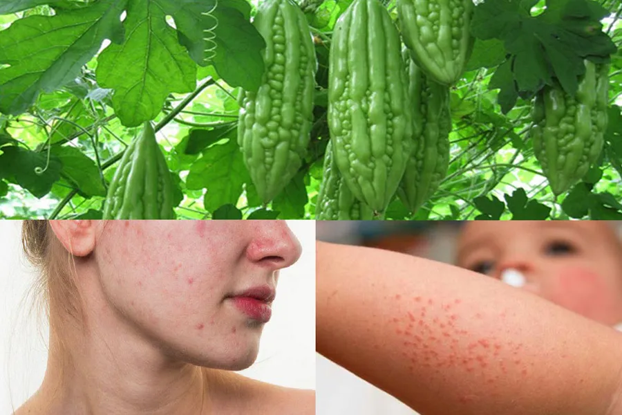 12 cách hỗ trợ làm sạch mụn đỏ, giảm mụn sưng đỏ nhanh chóng cấp tốc