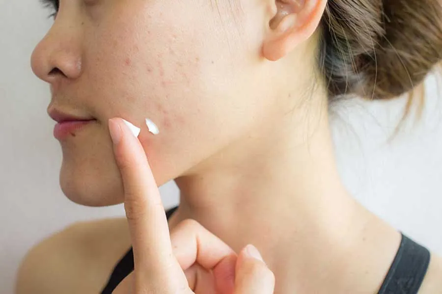 12 cách làm mờ sẹo thủy đậu thân thiện với làn da và rất nhanh chóng
