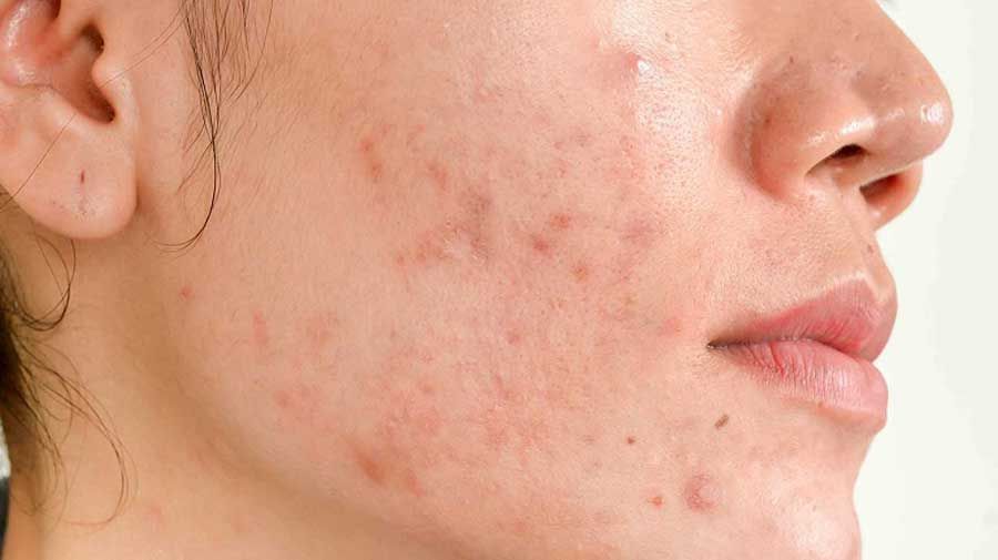 12 cách làm mờ sẹo thủy đậu thân thiện với làn da và rất nhanh chóng