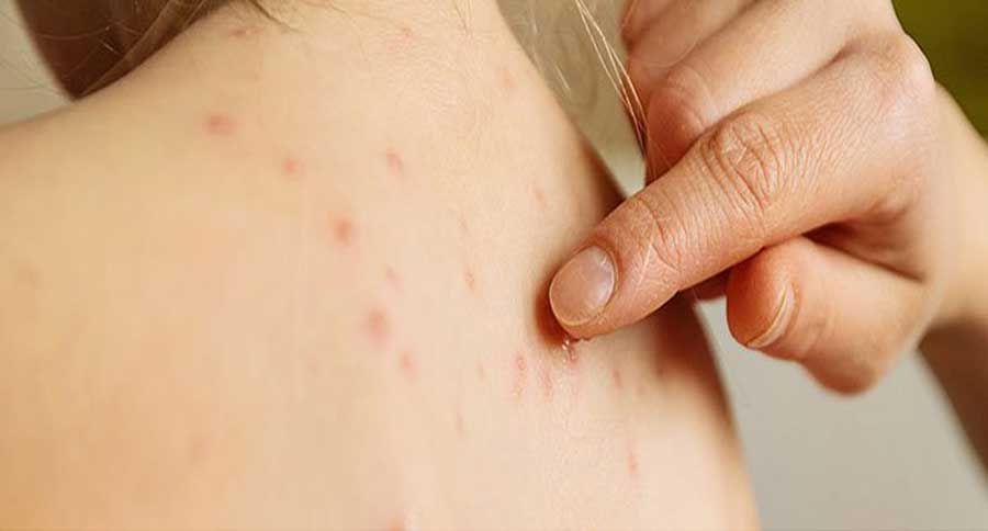 12 cách làm mờ sẹo thủy đậu thân thiện với làn da và rất nhanh chóng