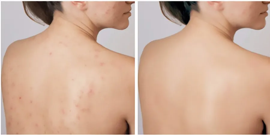 Top 6 kem hỗ trợ làm sạch mụn lưng triệt để cho nàng tự tin ngày hè - 1