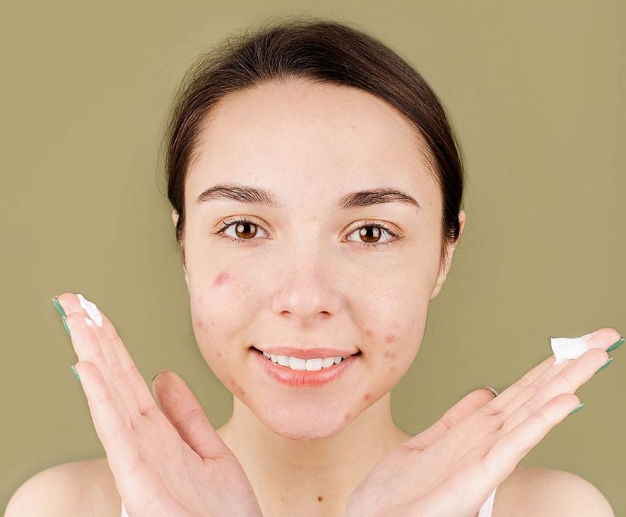 Thâm mụn bao lâu thì hết? Chọn kem trị hết thâm mụn trong 1 tuần