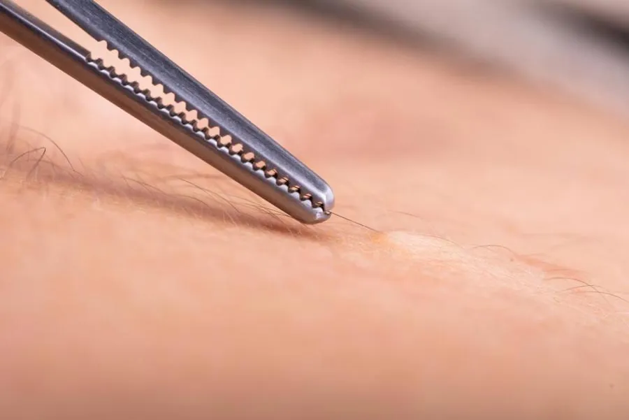 Gợi ý 10 cách tẩy sạch ria mép thân thiện với làn da cho nữ tại nhà