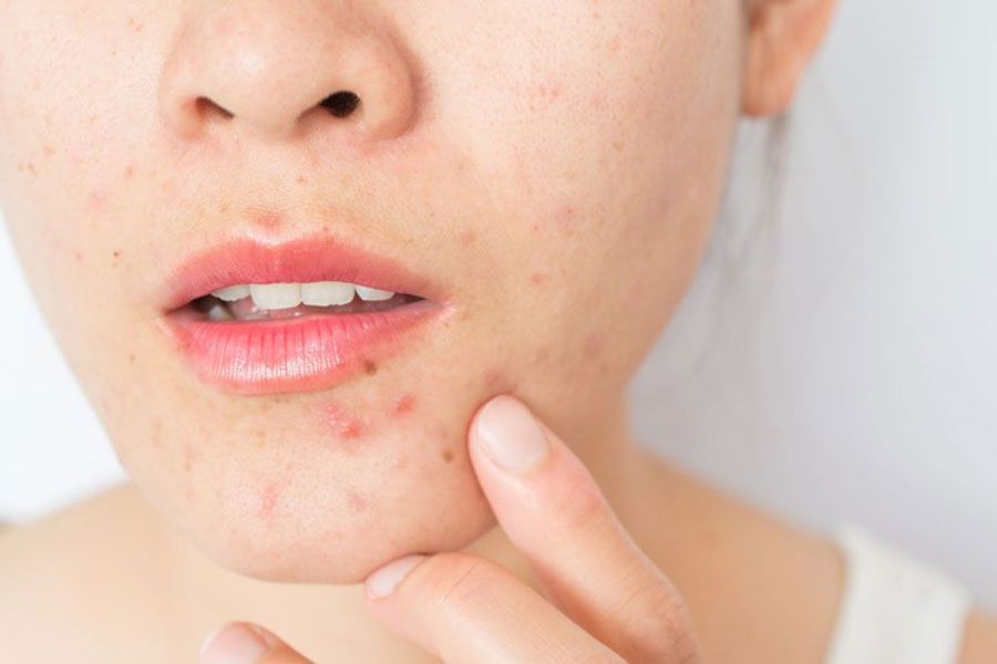 Mụn nội tiết tố là gì? Top 9 sản phẩm hỗ trợ làm sạch mụn nội tiết tố chất lượng tốt