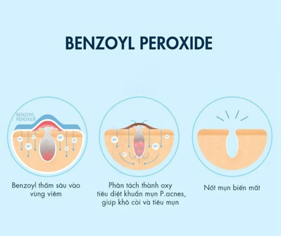 Mụn nội tiết tố là gì? Top 9 sản phẩm hỗ trợ làm sạch mụn nội tiết tố chất lượng tốt