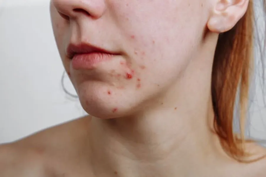 Nguyên nhân và cách hỗ trợ cải thiện mụn ở cằm hiệu quả nhanh chóng