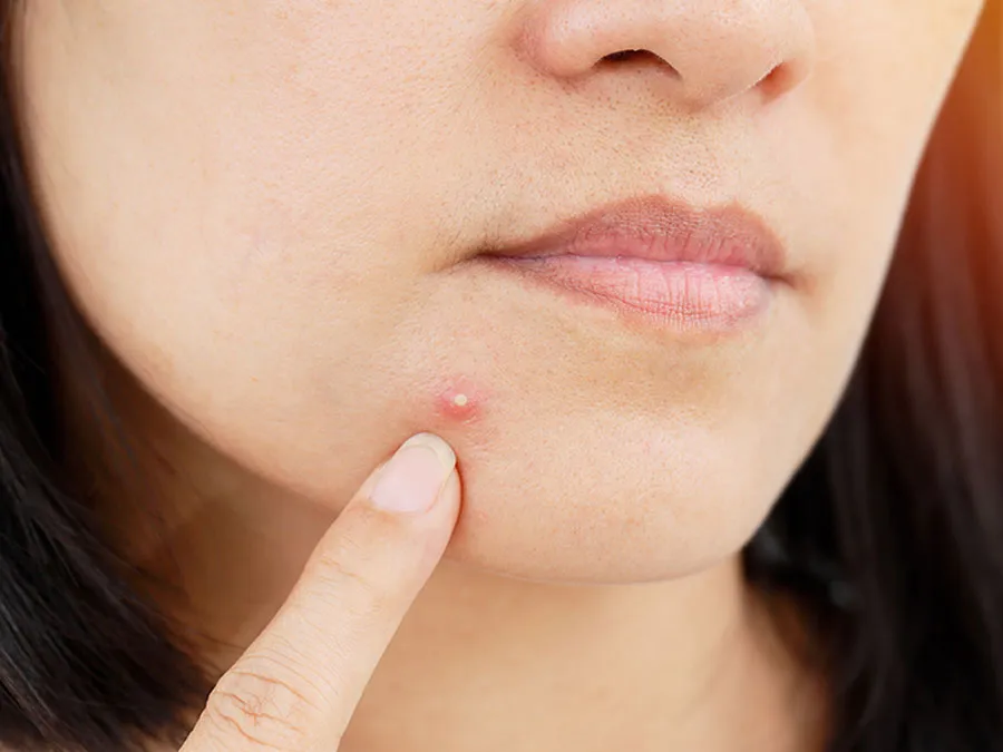 Nguyên nhân và cách hỗ trợ cải thiện mụn ở cằm hiệu quả nhanh chóng