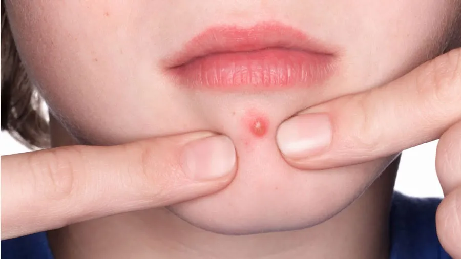 Nguyên nhân và cách hỗ trợ cải thiện mụn ở cằm hiệu quả nhanh chóng