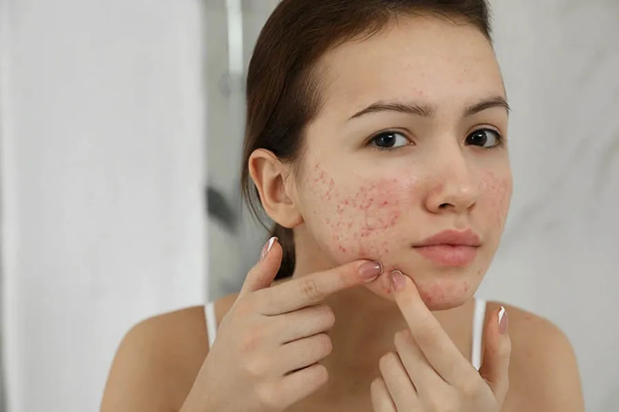Nguyên nhân và cách hỗ trợ cải thiện mụn ở cằm hiệu quả nhanh chóng