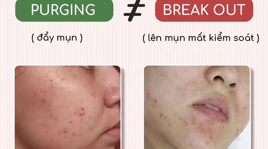 Purging là gì? Tổng hợp những việc cần làm trong quá trình Purging