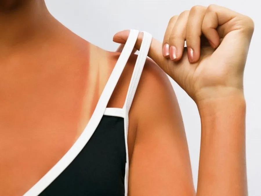 9 cách chữa da cháy nắng sau đi biển hiệu quả sau 5 ngày