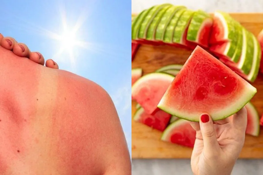 9 cách chữa da cháy nắng sau đi biển hiệu quả sau 5 ngày