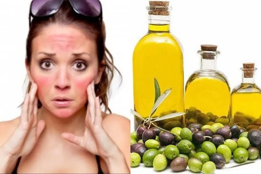 9 cách chữa da cháy nắng sau đi biển hiệu quả sau 5 ngày