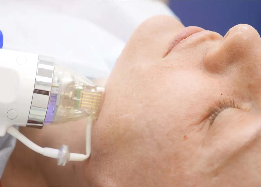 15 Cách trị sẹo rỗ do mụn hiệu quả và thân thiện với làn da hiện nay