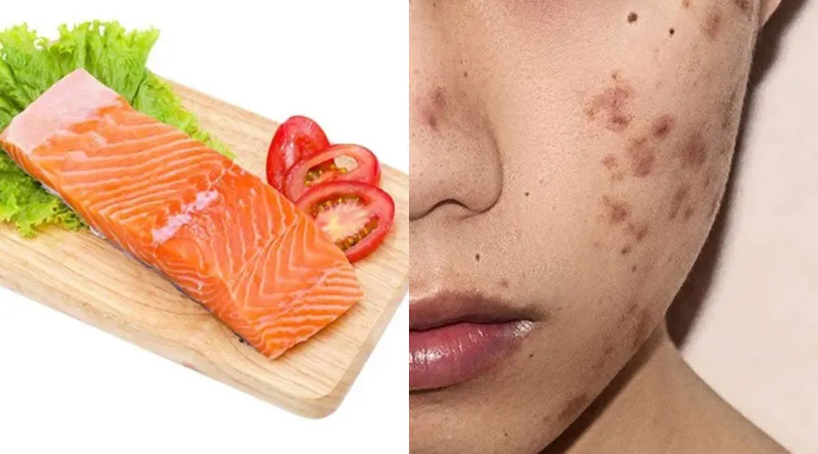 Ăn gì để sẹo lõm nhanh đầy? 10 món ăn tốt cho da bị sẹo lõm - 11