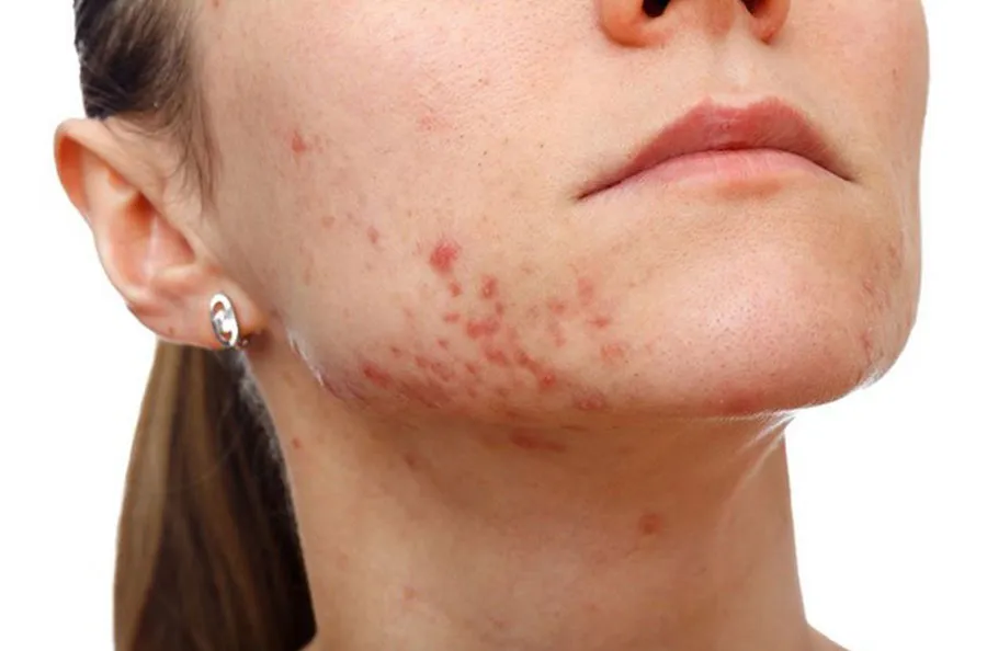 Ăn gì để sẹo lõm nhanh đầy? 10 món ăn tốt cho da bị sẹo lõm - 2