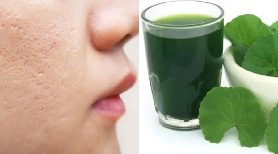 Ăn gì để sẹo lõm nhanh đầy? 10 món ăn tốt cho da bị sẹo lõm - 5