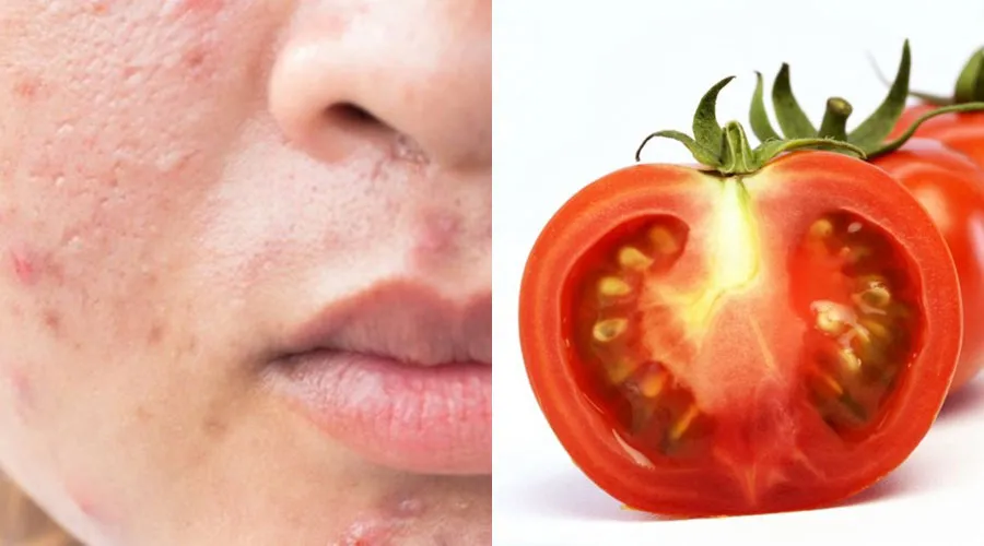 Ăn gì để sẹo lõm nhanh đầy? 10 món ăn tốt cho da bị sẹo lõm - 6