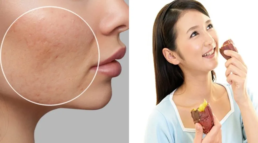 Ăn gì để sẹo lõm nhanh đầy? 10 món ăn tốt cho da bị sẹo lõm - 8