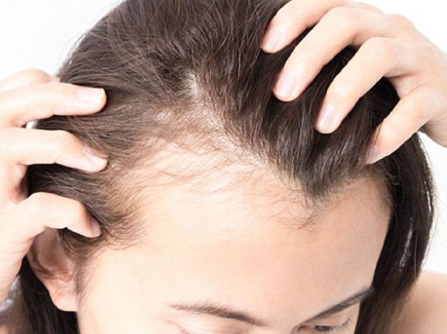 Top 10 cách trị ngứa da đầu tận gốc nhanh chóng