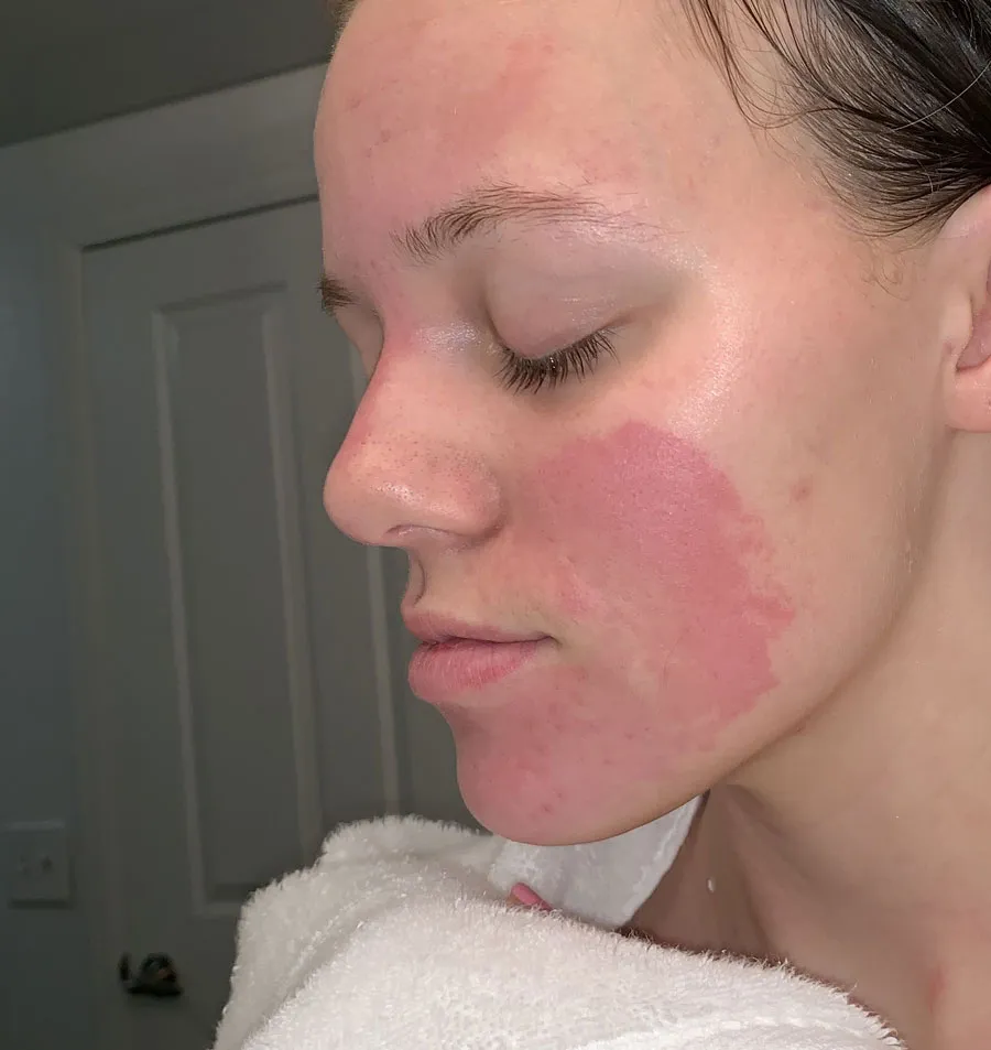 Dấu hiệu nhận biết bị dị ứng sữa rửa mặt và cách chữa hiệu quả - 1