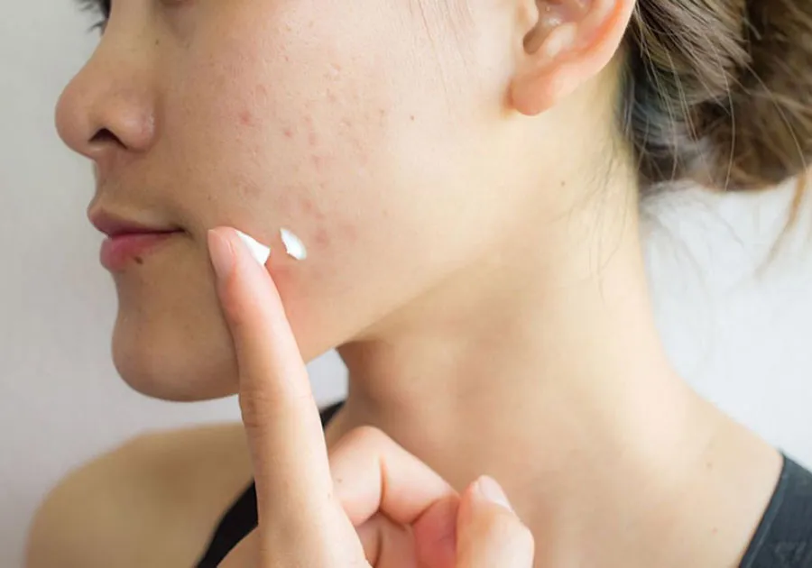 4 cách chăm sóc da mặt bị đen sạm, xỉn màu cấp tốc tại nhà