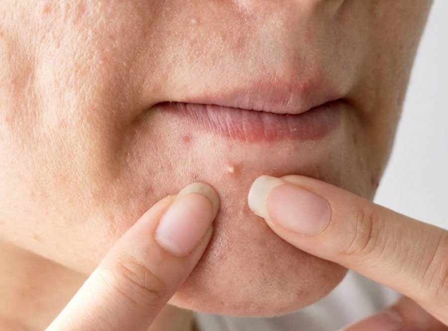 Mụn đầu trắng là gì? Nguyên nhân và cách hỗ trợ làm sạch mụn đầu trắng tại nhà hiệu quả