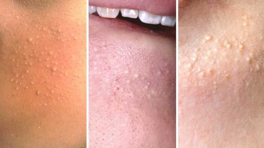 Mụn đầu trắng là gì? Nguyên nhân và cách hỗ trợ làm sạch mụn đầu trắng tại nhà hiệu quả