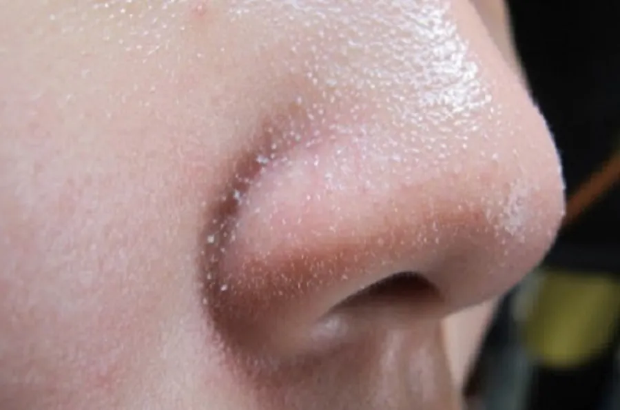 Mụn đầu trắng là gì? Nguyên nhân và cách hỗ trợ làm sạch mụn đầu trắng tại nhà hiệu quả