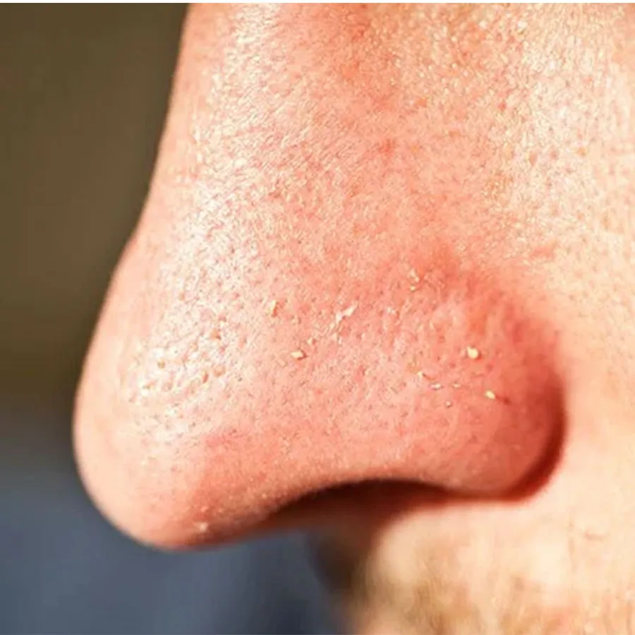 Sợi bã nhờn là gì? Nguyên nhân và cách trị sợi bã nhờn trên da mặt