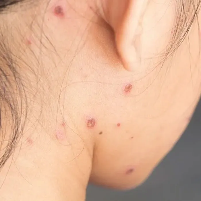 10 cách chăm sóc da sau khi bị thủy đậu nhanh cải thiện, không sẹo