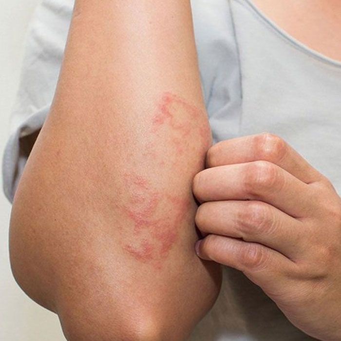 10 cách chăm sóc da sau khi bị thủy đậu nhanh cải thiện, không sẹo