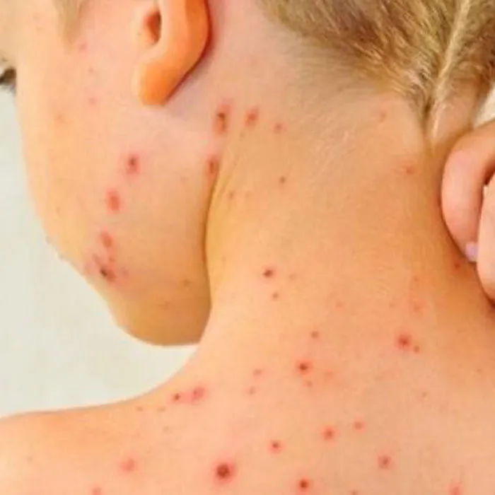 10 cách chăm sóc da sau khi bị thủy đậu nhanh cải thiện, không sẹo
