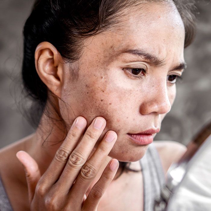 Da không đều màu là gì? 7 cách làm đều màu da hiệu quả - 1