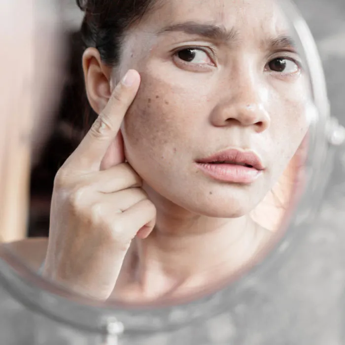 Da không đều màu là gì? 7 cách làm đều màu da hiệu quả - 2