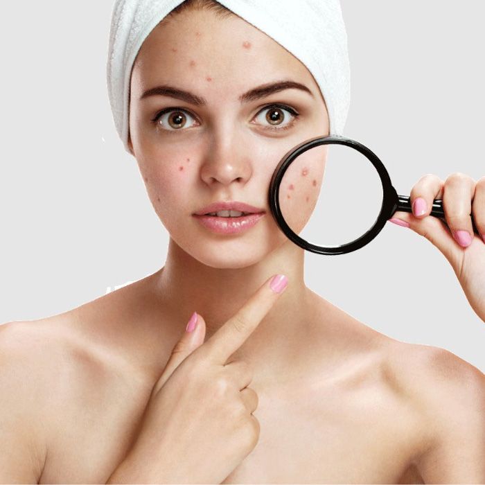 Review 3 loại kem hỗ trợ làm sạch mụn cho da dầu đem lại hiệu quả rõ rệt sau 1 tuần - 1