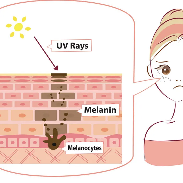 Melanin là gì? Lợi ích với làn da và những rối loạn liên quan - 2