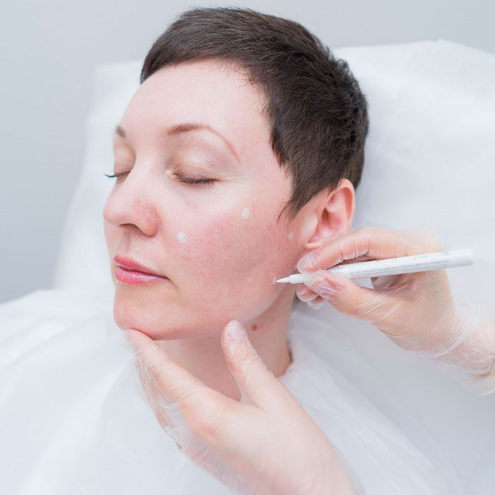 Tiêm Mesotherapy là gì? Cách chăm sóc da trước và sau khi tiêm Mesotherapy - 12