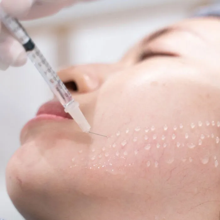 Tiêm Mesotherapy là gì? Cách chăm sóc da trước và sau khi tiêm Mesotherapy - 5
