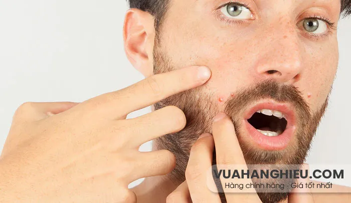9 cách chăm sóc da mụn cho nam hiệu quả nhanh chóng