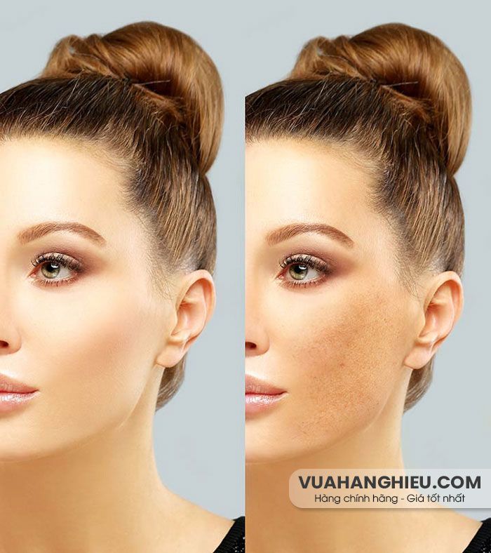 Cách ngăn ngừa nám da khi mang thai: Nguyên nhân, biện pháp và phòng ngừa