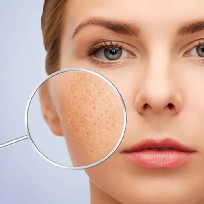 11 cách thu nhỏ lỗ chân lông ở mặt thân thiện với làn da, hiệu quả ngay tại nhà