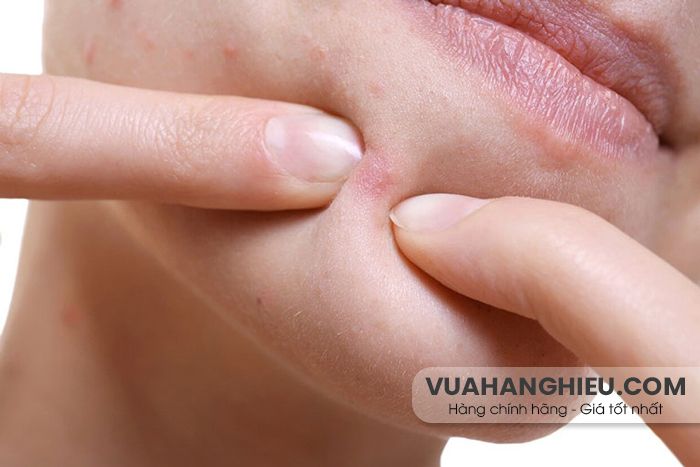 24 cách hỗ trợ làm sạch mụn ẩn bằng thiên nhiên thân thiện với làn da và hiệu quả tại nhà