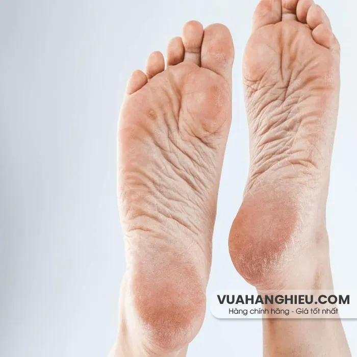 11 Cách trị nứt gót chân từ thiên nhiên hiệu quả tại nhà