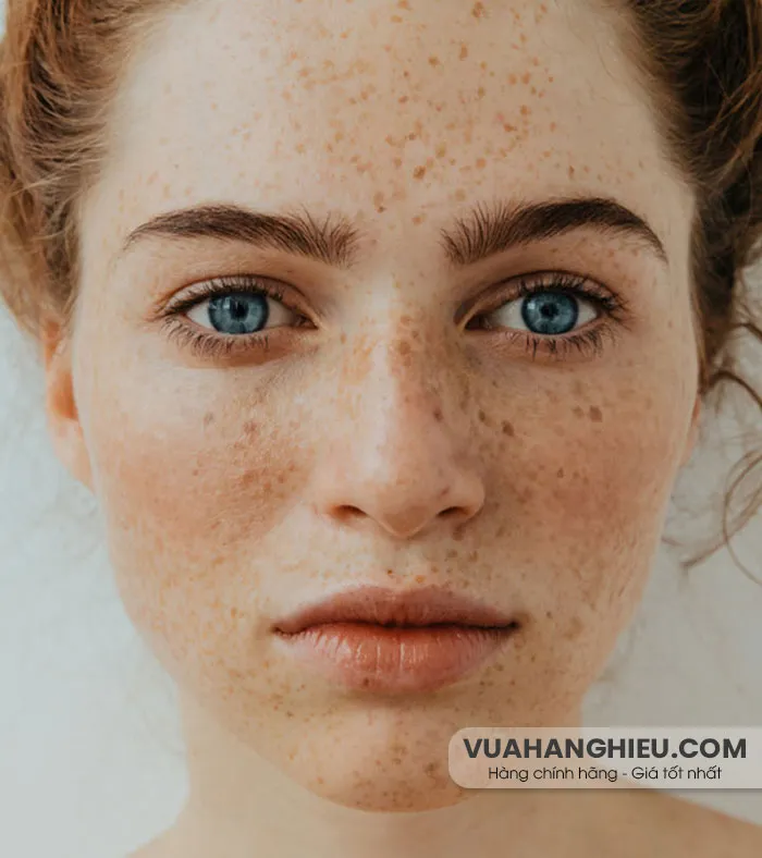 12 cách trị tàn nhang từ thiên nhiên hiệu quả tại nhà