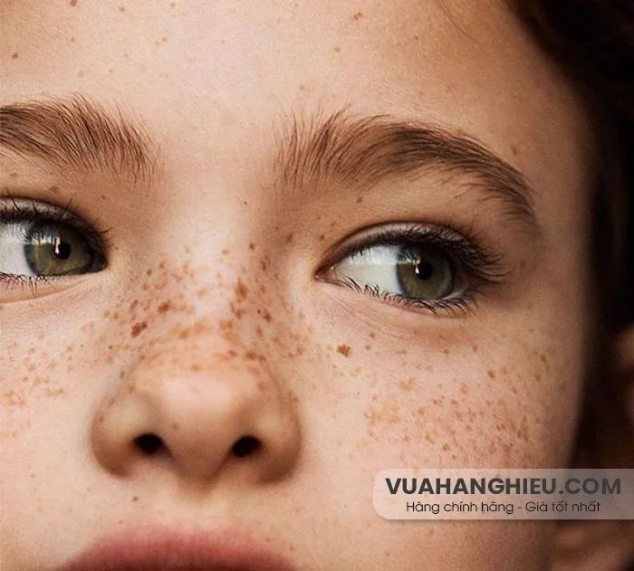 12 cách trị tàn nhang từ thiên nhiên hiệu quả tại nhà
